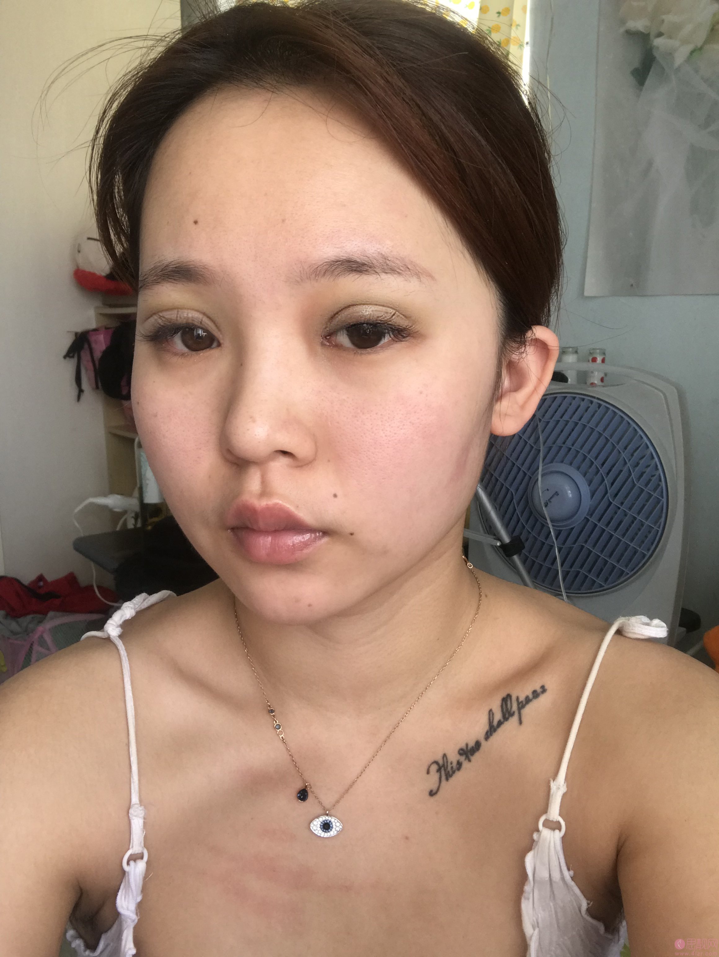 山东省立医院整形美容科霍然做双眼皮怎么样?附双眼皮案例及2020价格表曝光