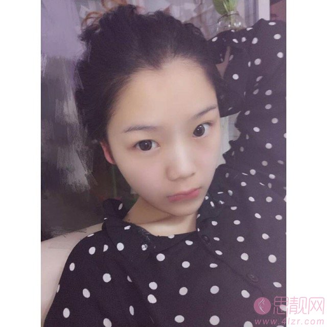 上海东方医院整形美容科做双眼皮手术怎么样?2020价格表曝光+双眼皮真人案例一览