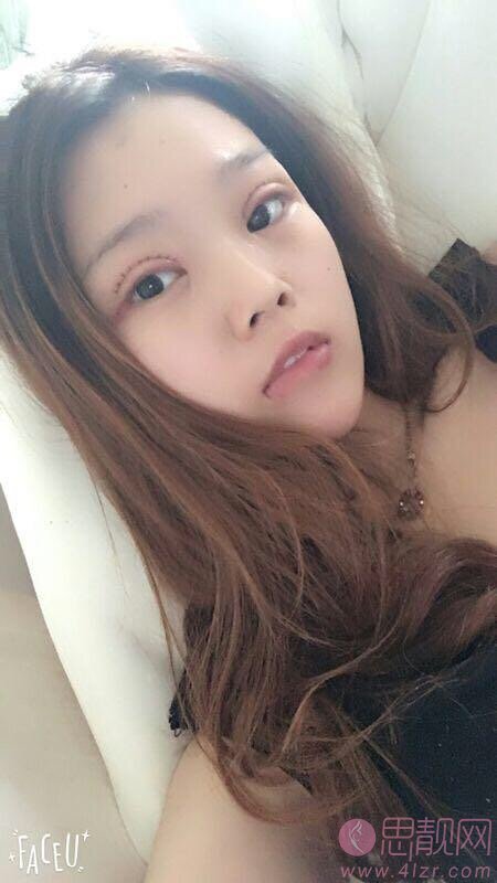 上海东方医院整形美容科做双眼皮手术怎么样?2020价格表曝光+双眼皮真人案例一览