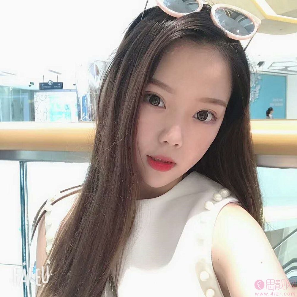 上海东方医院整形美容科做双眼皮手术怎么样?2020价格表曝光+双眼皮真人案例一览