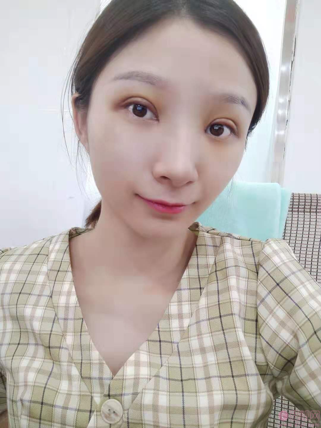 深圳北大医院做双眼皮多少钱？2020价格表曝光+双眼皮真人案例分享