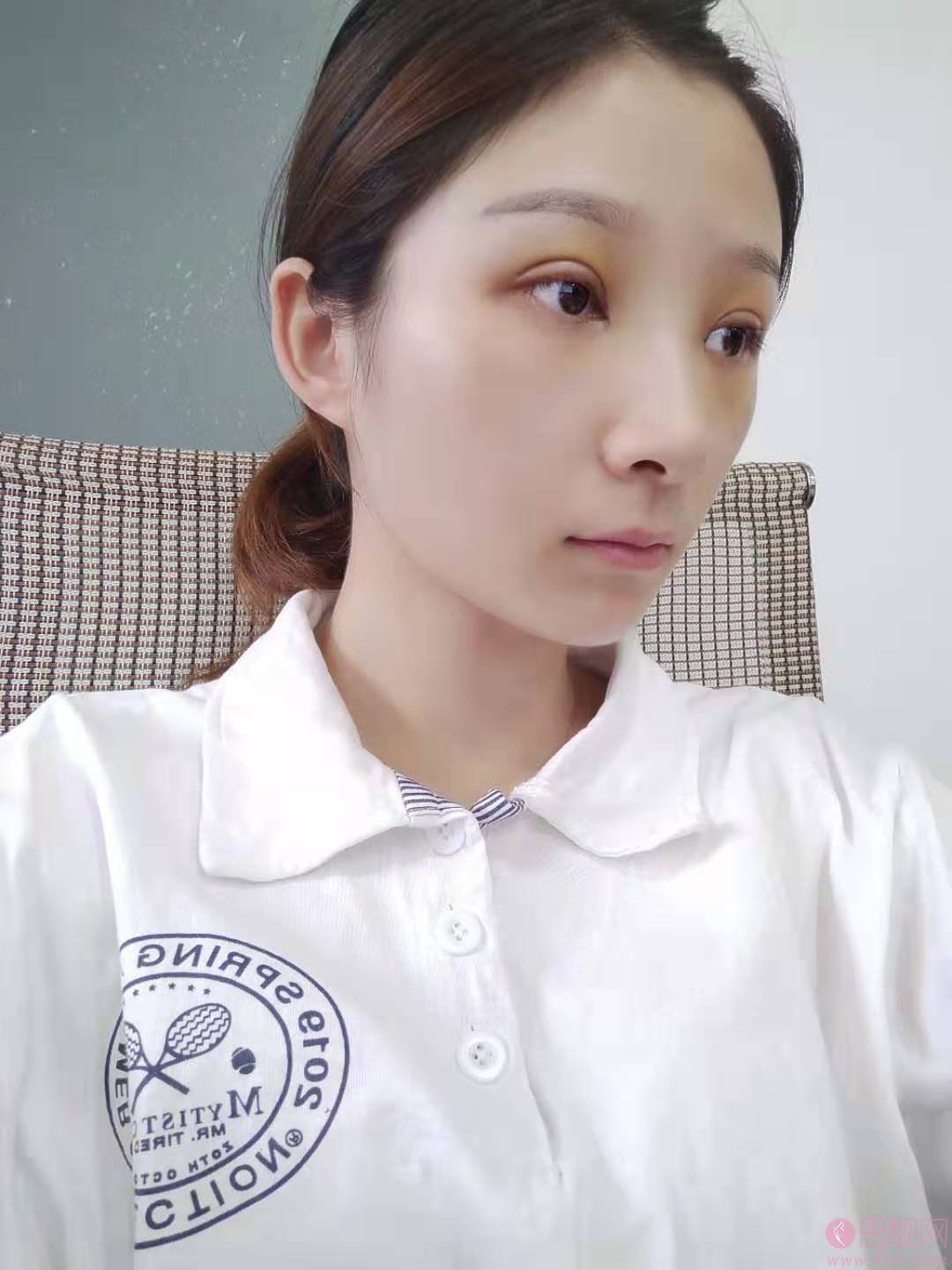 深圳北大医院做双眼皮多少钱？2020价格表曝光+双眼皮真人案例分享