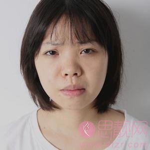 贵阳美莱医疗美容医院隆鼻怎么样?附隆鼻案例及2020价格表一览