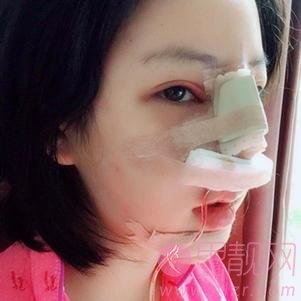 贵阳美莱医疗美容医院隆鼻怎么样?附隆鼻案例及2020价格表一览