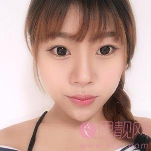 大连明医汇整形美容刘崴隆鼻好不好？附隆鼻前后案例对比及2020价格表曝光
