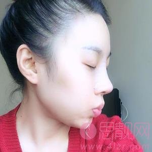 大连明医汇整形美容刘崴隆鼻好不好？附隆鼻前后案例对比及2020价格表曝光