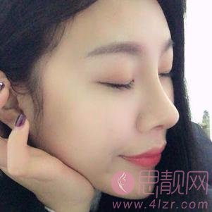 大连明医汇整形美容刘崴隆鼻好不好？附隆鼻前后案例对比及2020价格表曝光