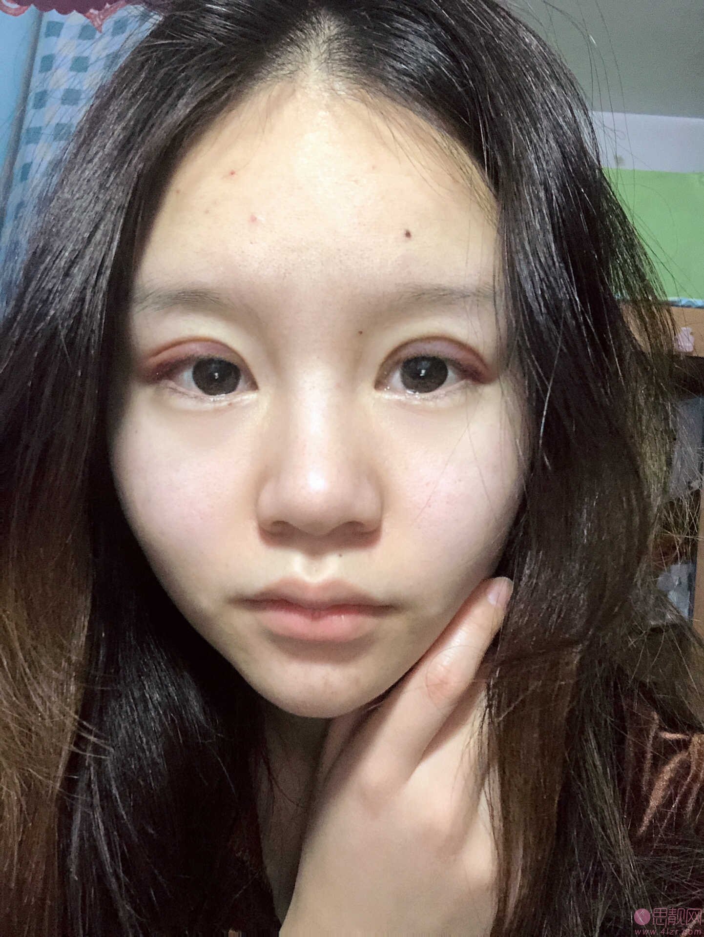 珠江医院蒋萱双眼皮案例？附2020价格表爆光+双眼皮真人案例一览