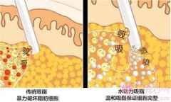 水动力吸脂和360环吸的区别