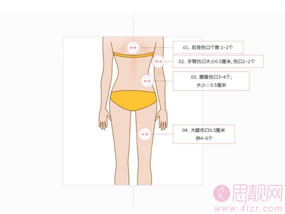 水动力吸脂和360环吸的区别