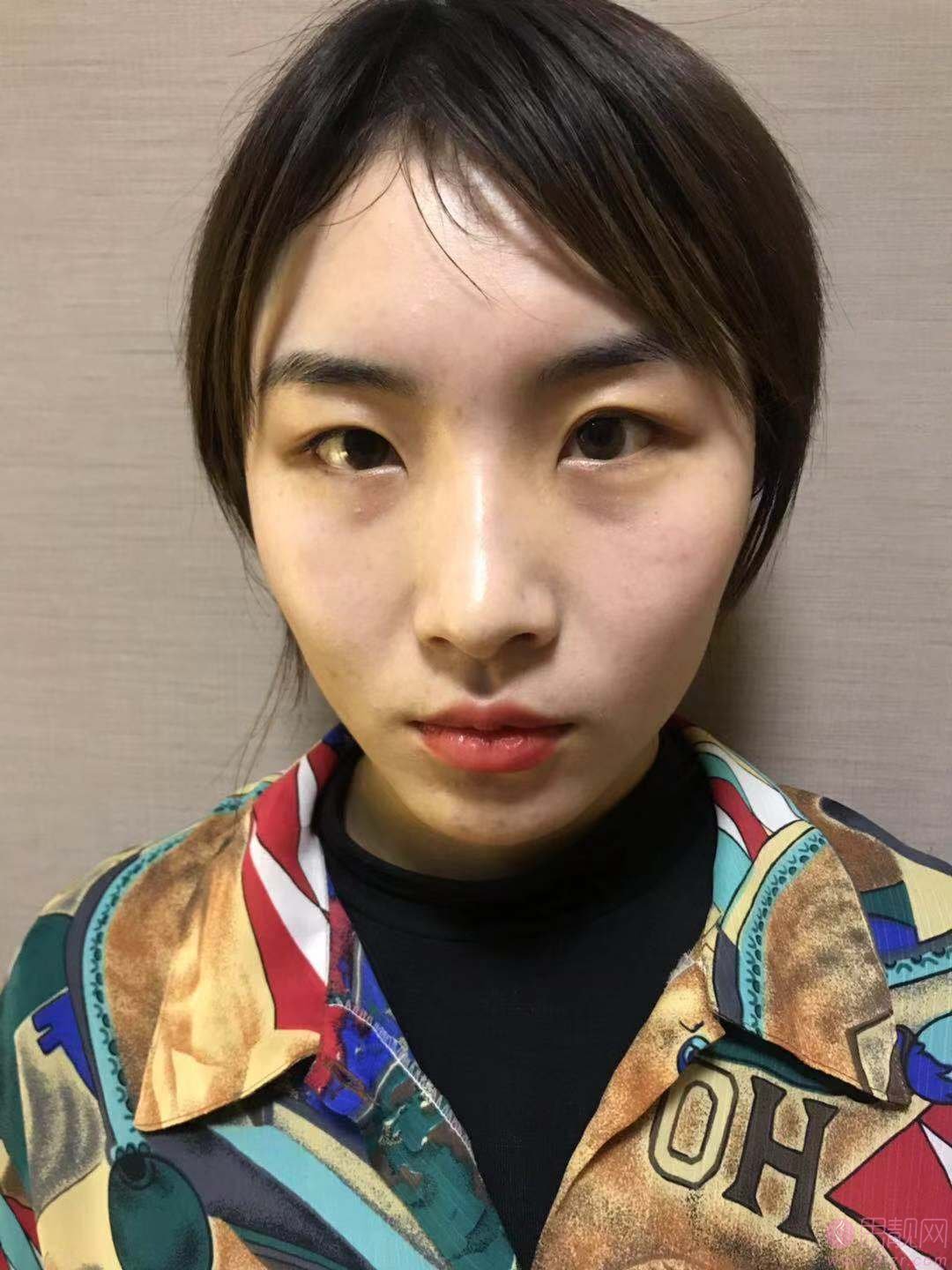 深圳春天医院做双眼皮怎么样?附双眼皮真人案例及2020价格表发布