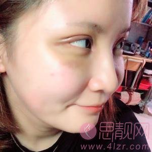 北京同仁医院整形美容中心双眼皮案例一览及2020价格表公开