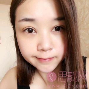 陈芝和潘贰谁修复做得更好？附双眼皮案例及2020价格表发布