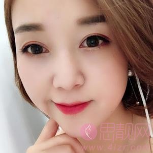 陈芝和潘贰谁修复做得更好？附双眼皮案例及2020价格表发布