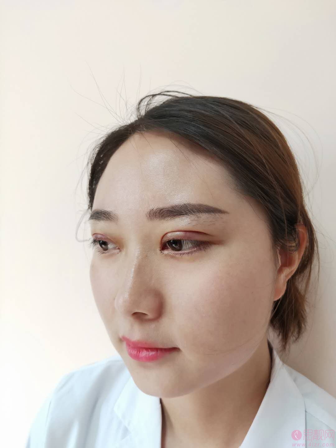 成都刘辅容眼部修复怎么样？附双眼皮案例一览及2020价格表出炉