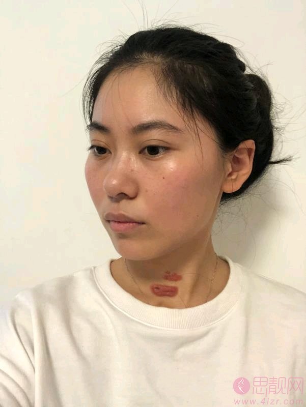 济南韩式整形医院祛疤好不好？附祛疤真人案例一览及2020价格表发布