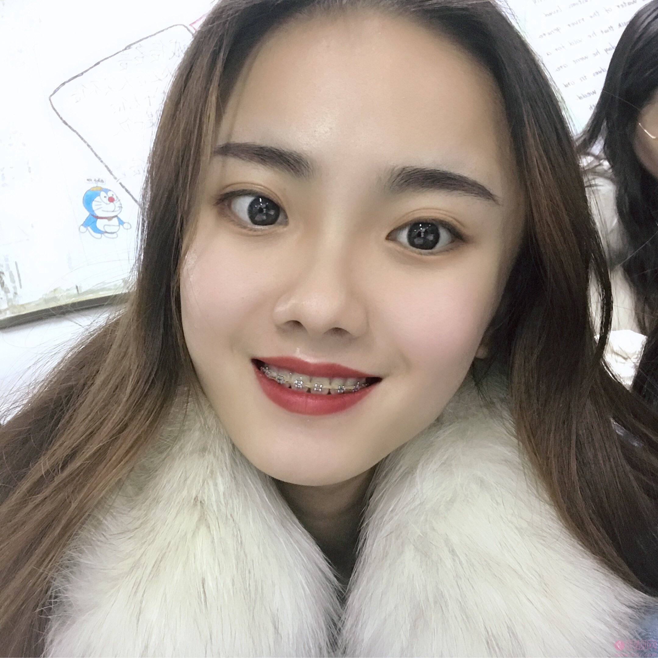 拜博口腔和维乐口腔哪个好？附牙齿矫正真人案例一览