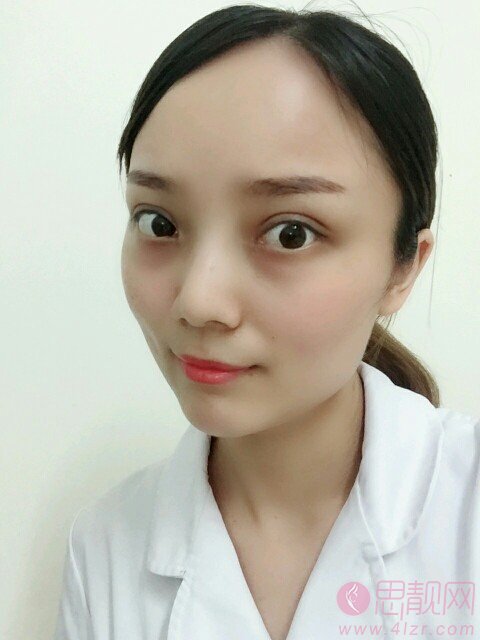北京八大处杨晓楠双眼皮修复案例？附2020价格表一览