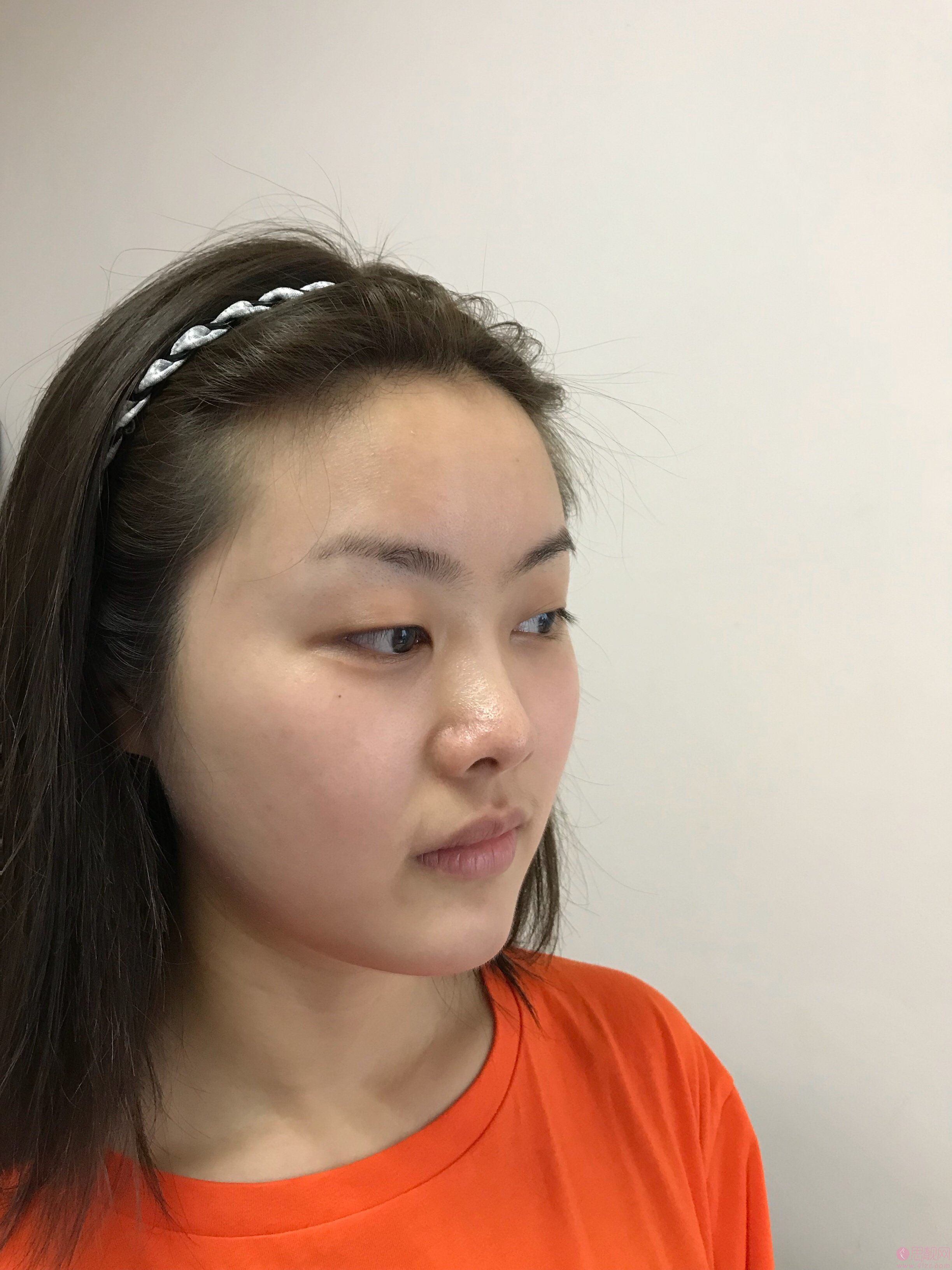 成都西区医院车红昌做双眼皮手术怎么样？附双眼皮案例一览及2020价格表曝光