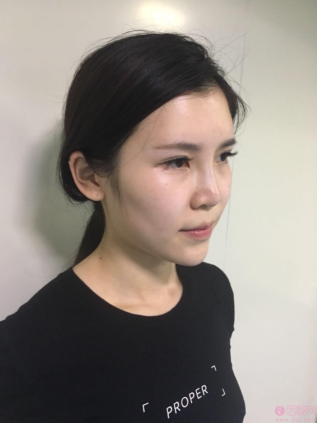成都仪美美仁周仪做肋骨鼻怎么样？附隆鼻真人反馈及2020价格表公开