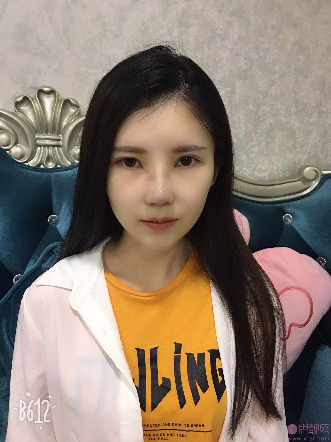 成都仪美美仁周仪做肋骨鼻怎么样？附隆鼻真人反馈及2020价格表公开