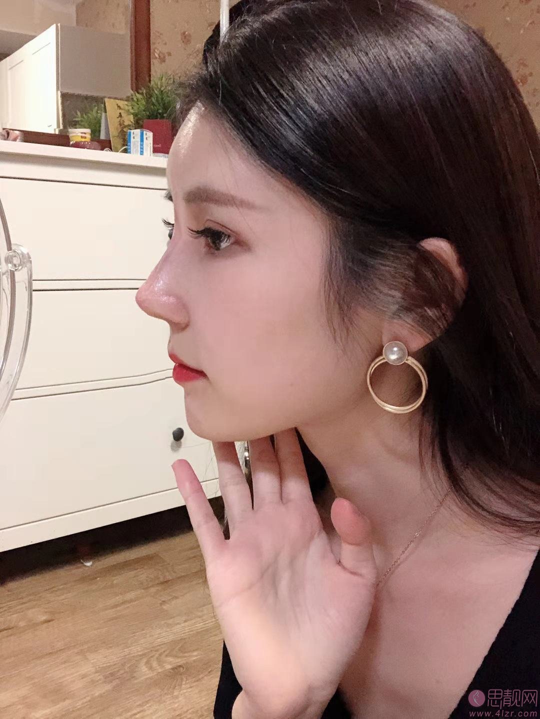 成都仪美美仁周仪做肋骨鼻怎么样？附隆鼻真人反馈及2020价格表公开