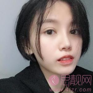 杭州美莱整形医院高士乾做双眼皮怎么样？附双眼皮案例及2020价格表公开