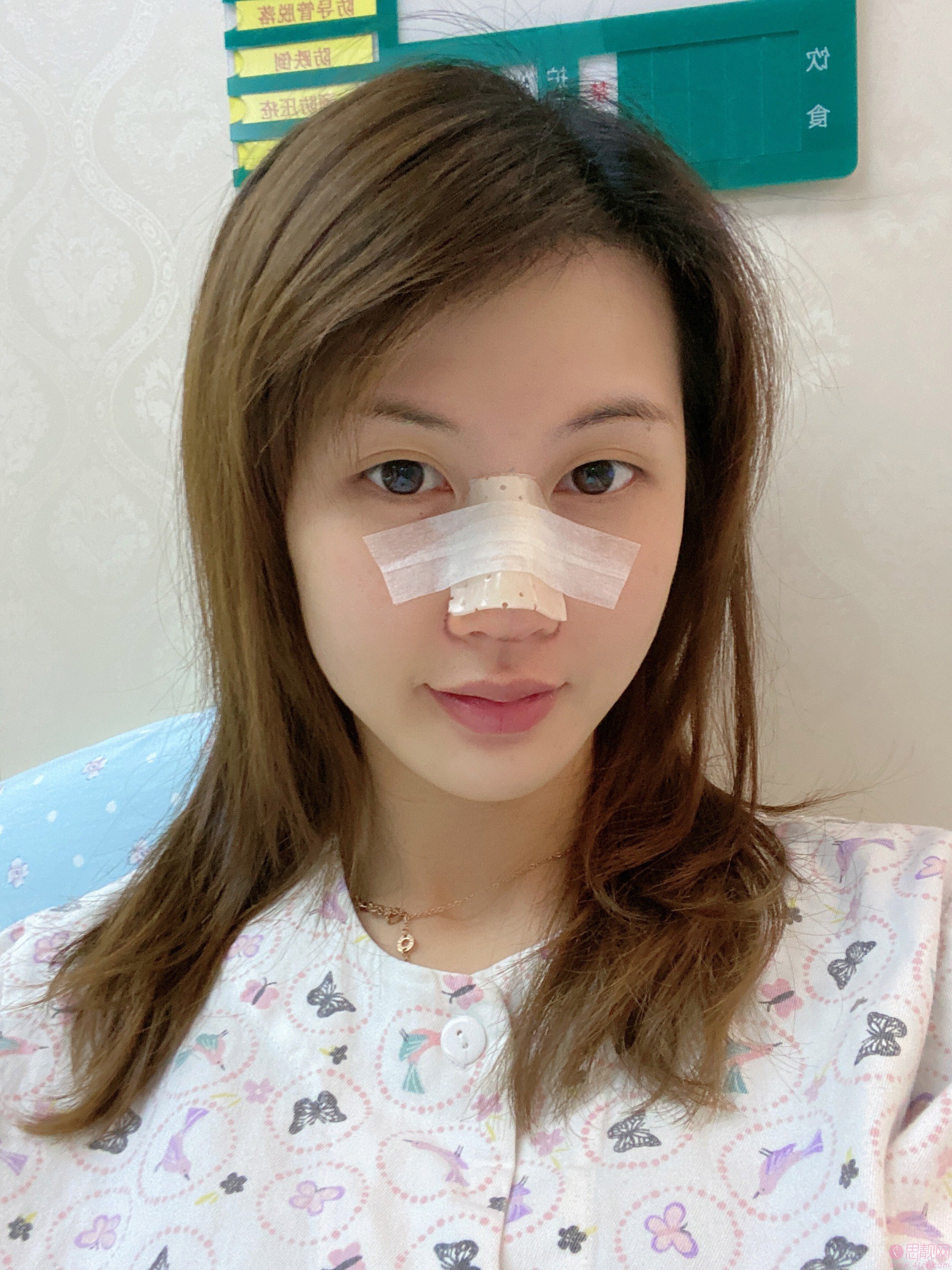 上海蝶可变医疗美容王志鹏做鼻子怎么样附隆鼻案例及2020价格表发布