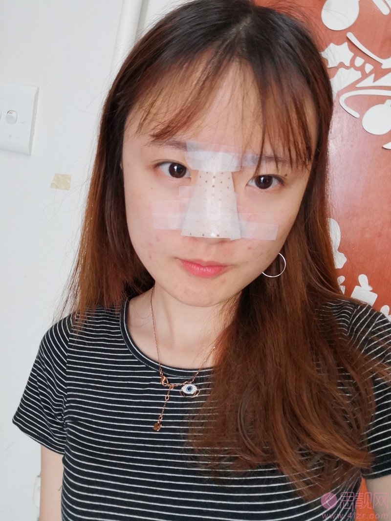 北京愉悦田秋梅隆鼻好不好？附隆鼻案例及价格表