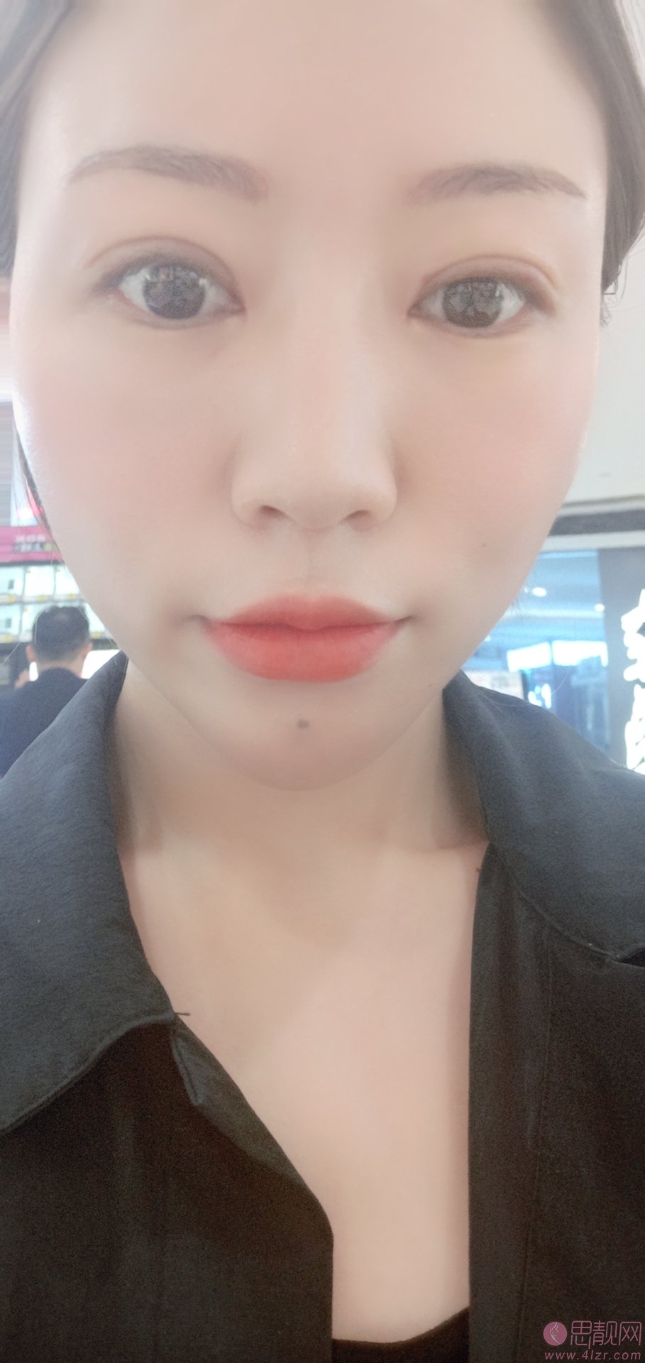 杭州时光吕敏做双眼皮怎么样？附双眼皮案例一览及2020价格表公开