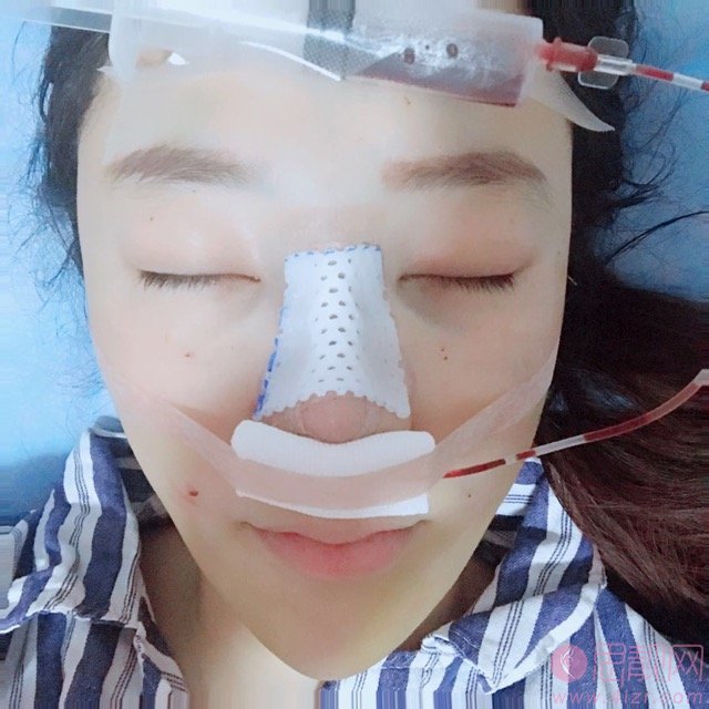 华美胡凯做鼻子如何？附隆鼻案例及2020价格表曝光