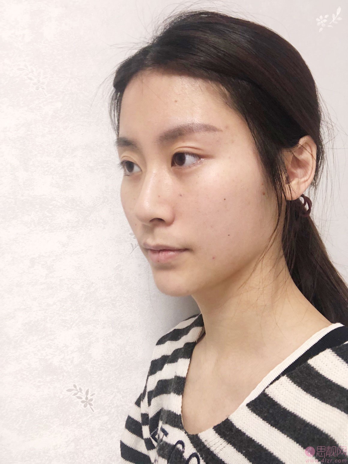 珠海新颜医疗美容苏锦和做埋线提升怎么样？附案例及2020价格表一览
