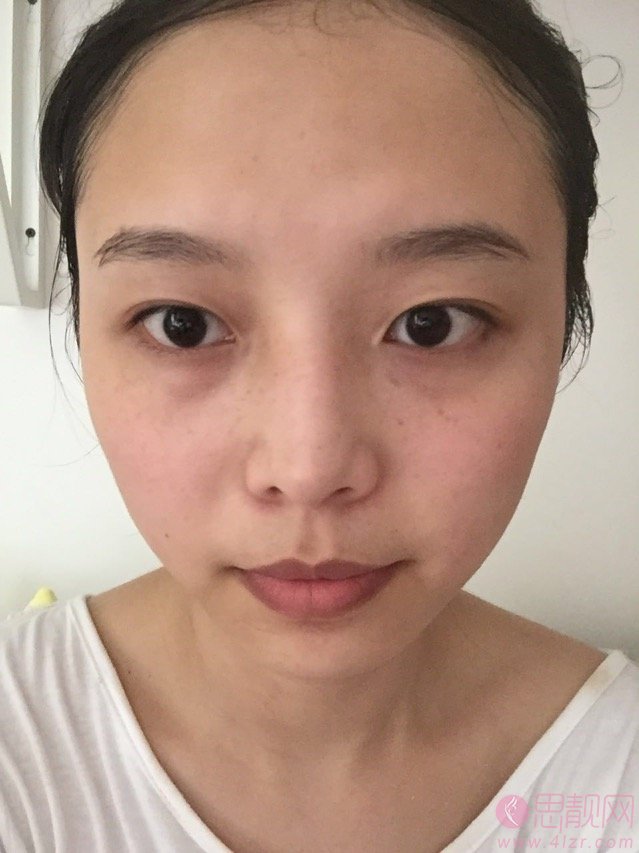 中南大学湘雅三医院做双眼皮怎么样？附双眼皮案例及2020价格表曝光