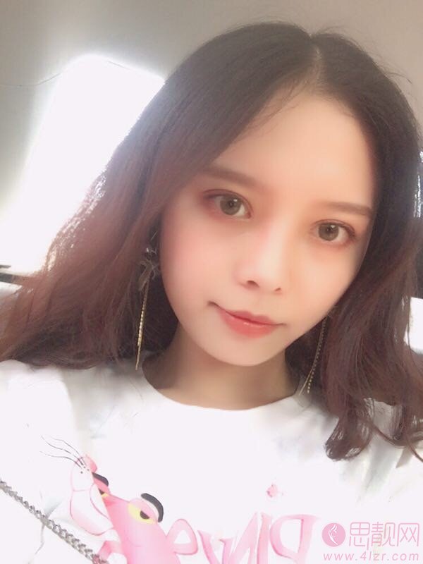 中南大学湘雅三医院做双眼皮怎么样？附双眼皮案例及2020价格表曝光