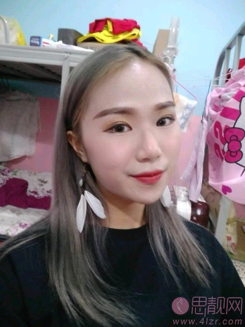 许昌市立医院整形科做双眼皮手术好不好？附双眼皮真人案例反馈