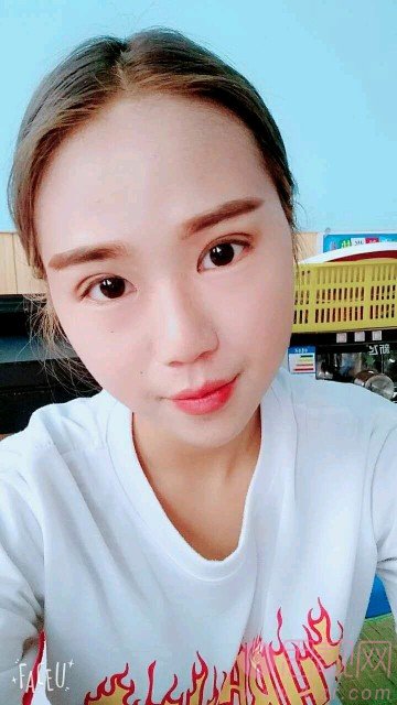 许昌市立医院整形科做双眼皮手术好不好？附双眼皮真人案例反馈