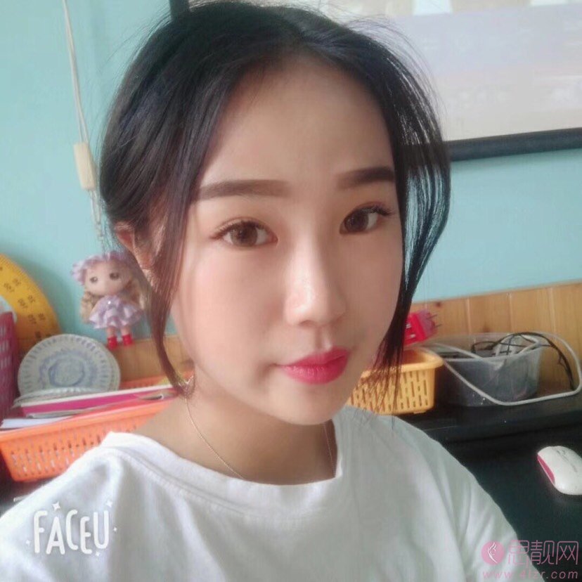 许昌市立医院整形科做双眼皮手术好不好？附双眼皮真人案例反馈