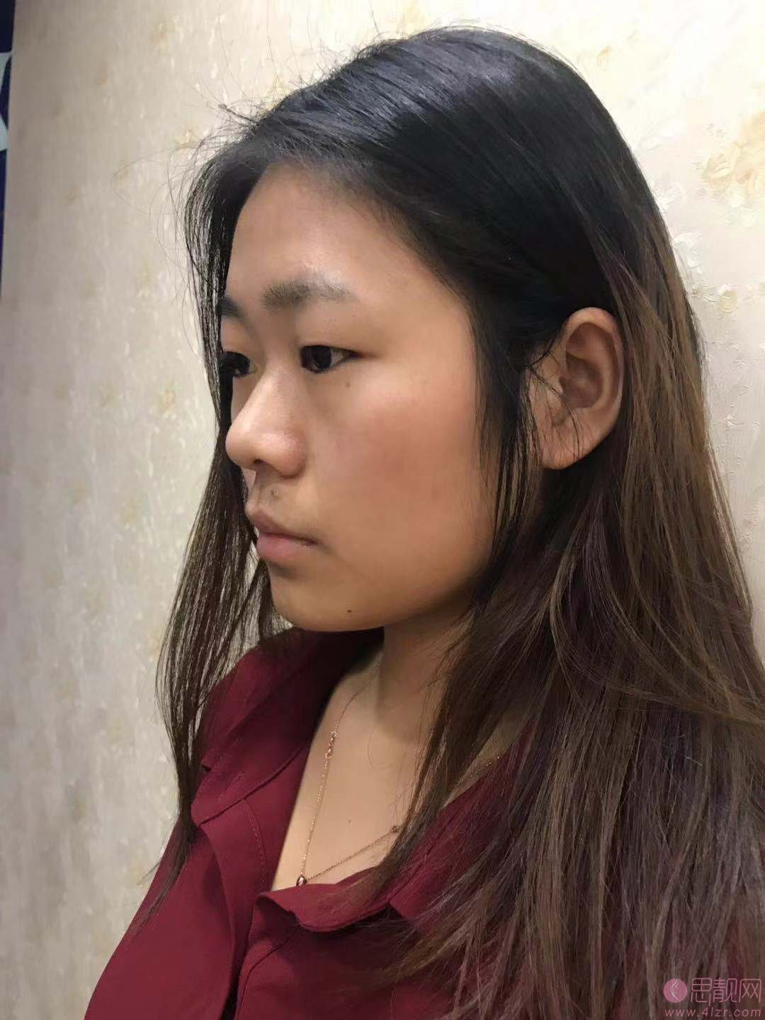 陕西省友谊医院整形外科张洁做双眼皮怎么样？附双眼皮案例及2020价格表曝光