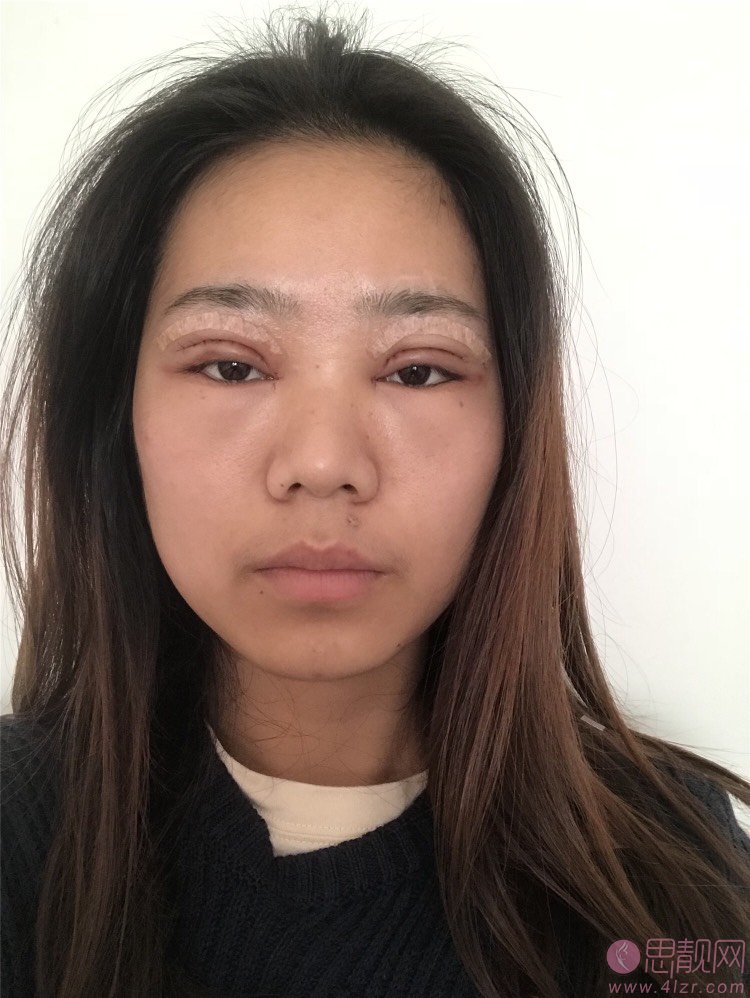 陕西省友谊医院整形外科张洁做双眼皮怎么样？附双眼皮案例及2020价格表曝光