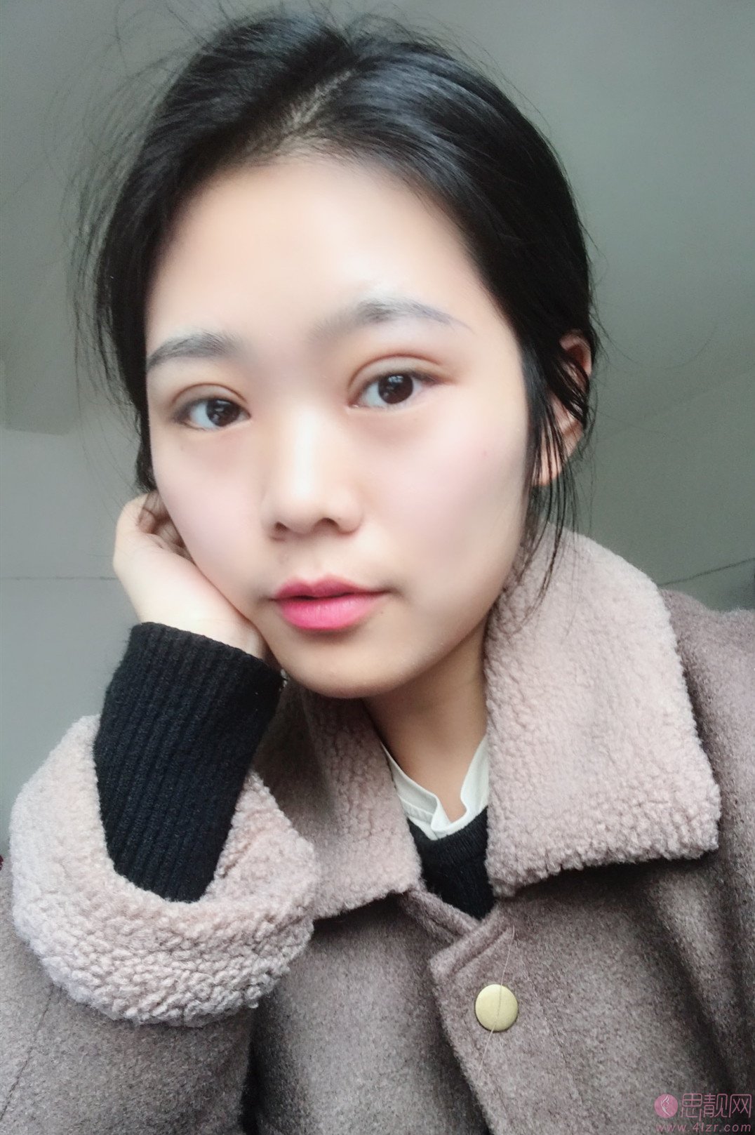 陕西省友谊医院整形外科张洁做双眼皮怎么样？附双眼皮案例及2020价格表曝光