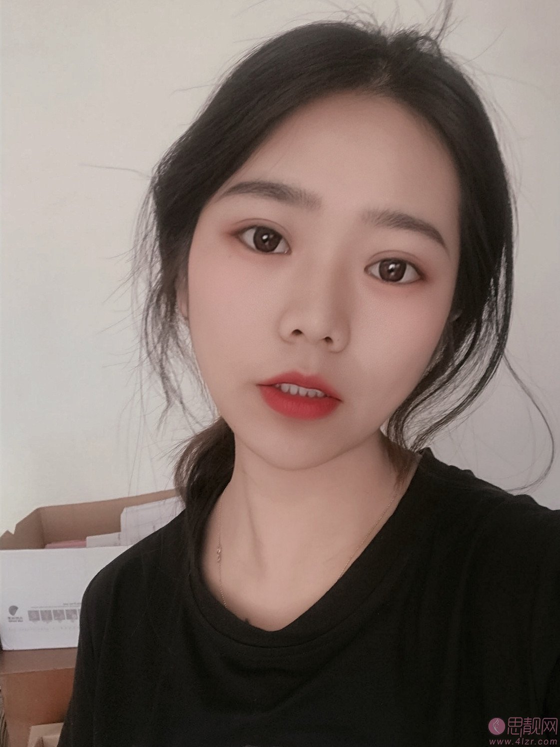 陕西省友谊医院整形外科张洁做双眼皮怎么样？附双眼皮案例及2020价格表曝光