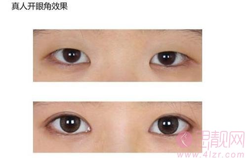 韩式无痕开眼角有什么特点？适合那类人群