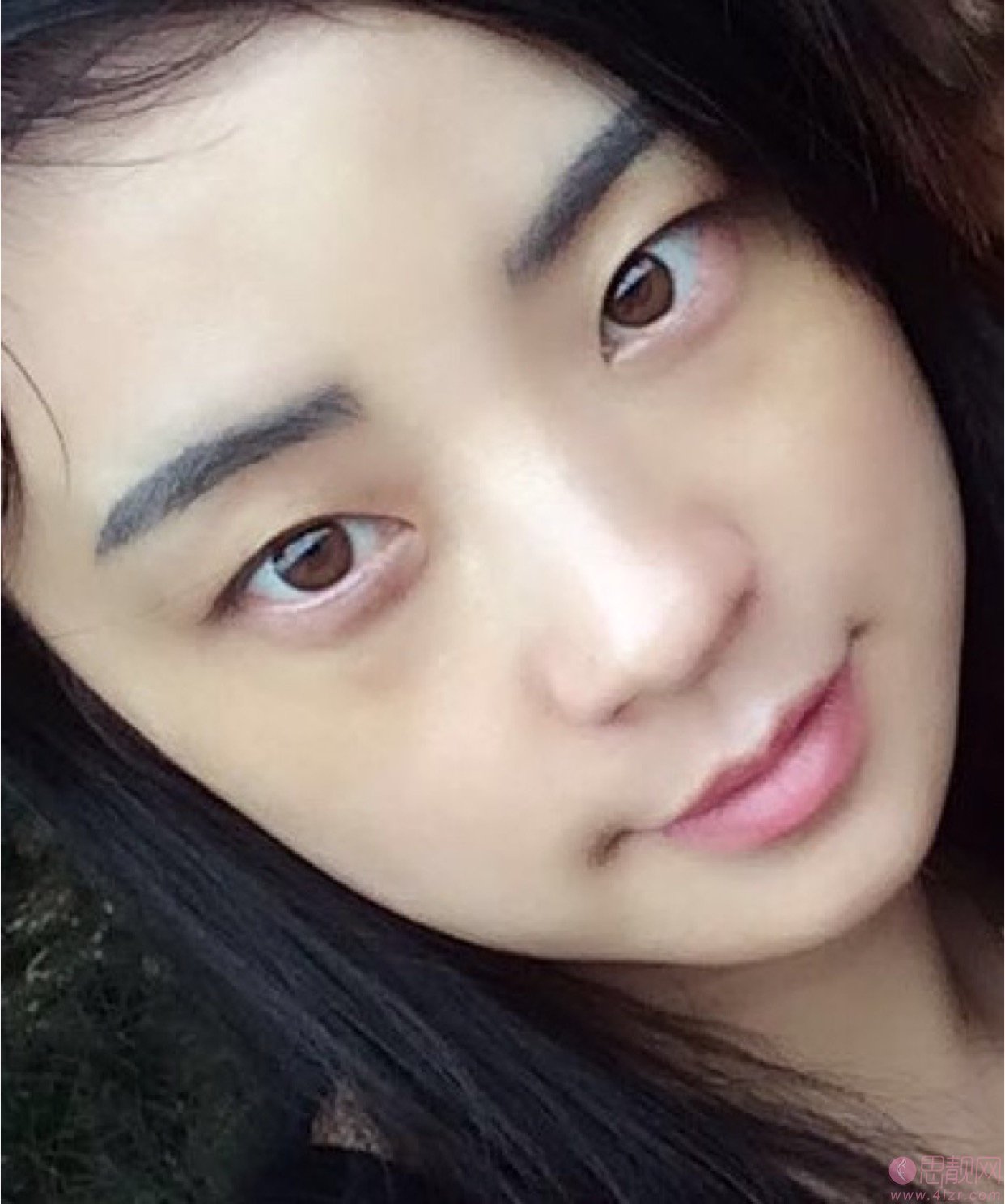 浙江省人民医院吴溯帆割的双眼皮，看看效果怎么样吧！2020价格表一览