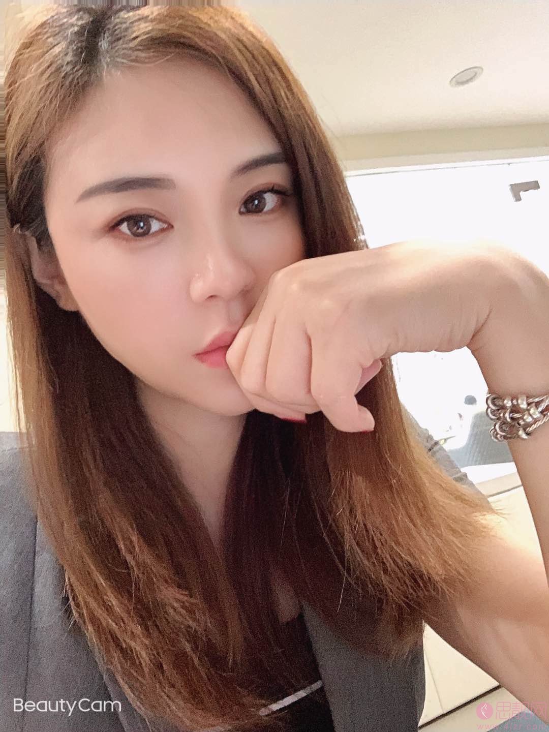 浙江省人民医院吴溯帆割的双眼皮，看看效果怎么样吧！2020价格表一览
