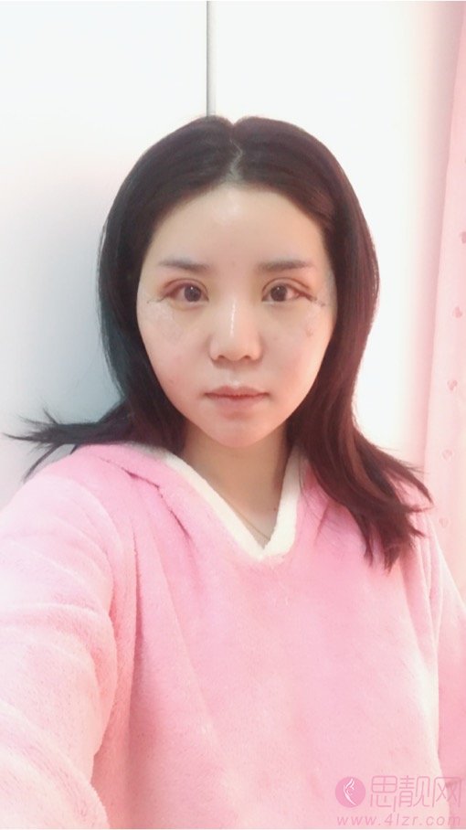 石杭燕做双眼皮怎么样?附双眼皮案例一览及2020价格表曝光