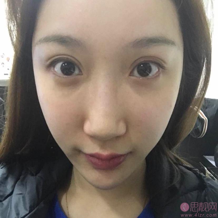 大连爱德丽格整形刘志刚做眼修复手术怎么样?附双眼皮修复案例及2020价格表发布