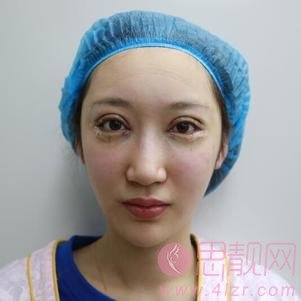 大连爱德丽格整形刘志刚做眼修复手术怎么样?附双眼皮修复案例及2020价格表发布