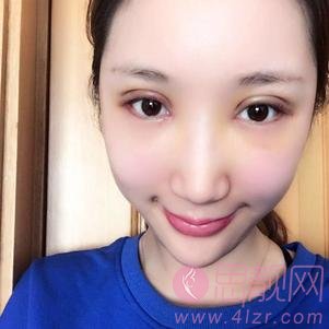大连爱德丽格整形刘志刚做眼修复手术怎么样?附双眼皮修复案例及2020价格表发布