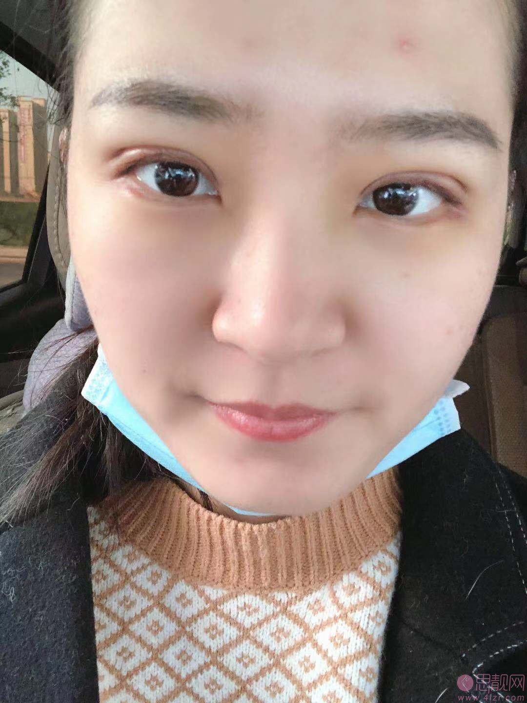 王太玲双眼皮修复怎么样?附双眼皮修复案例一览及2020价格表爆光