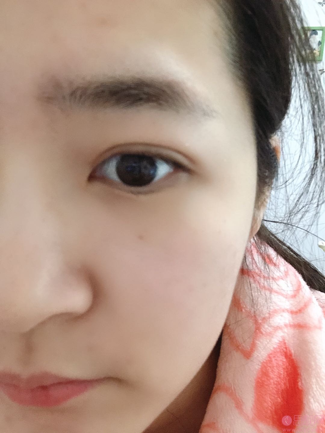 王太玲双眼皮修复怎么样?附双眼皮修复案例一览及2020价格表爆光
